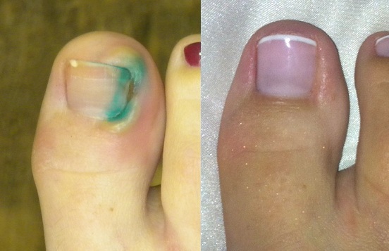 ingrown toe nail cyprus 5.jpg